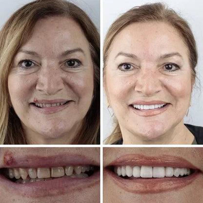 Ends Today: 49% OFF! ⏰ KLENIMORE™ Custom-Fit Smile Support Set — Strong Hold & Natural Look 🦷
